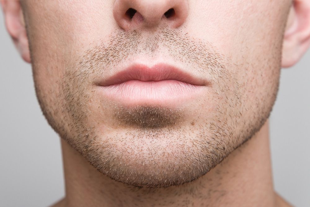 caucasian man facial hair chin surgery augmentation