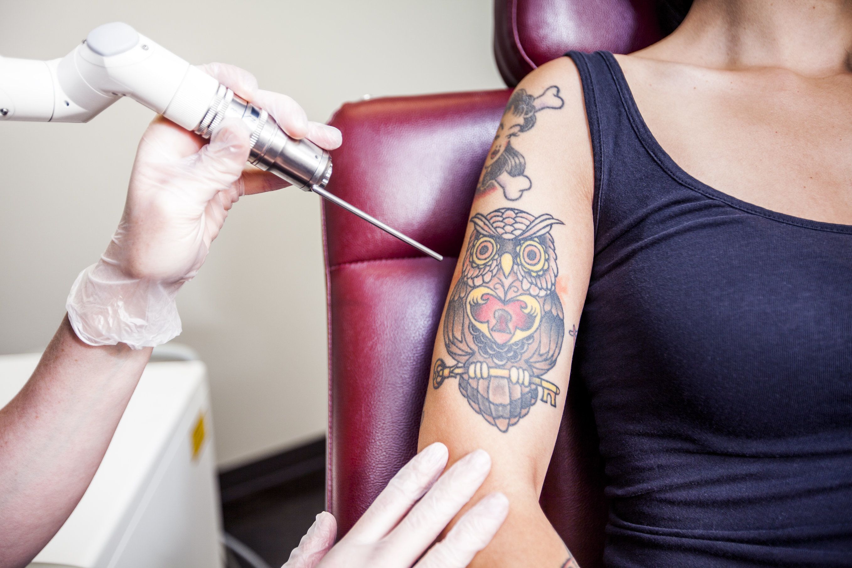 Photo of a woman getting a tattoo removed
