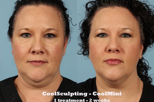 Before and after coolmini treatment