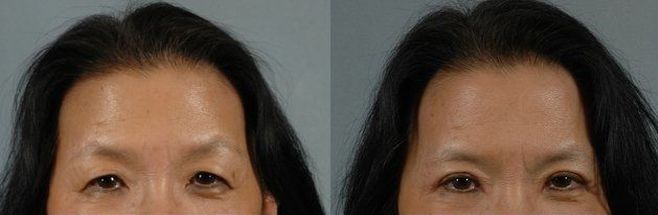 Asian eyelid surgery