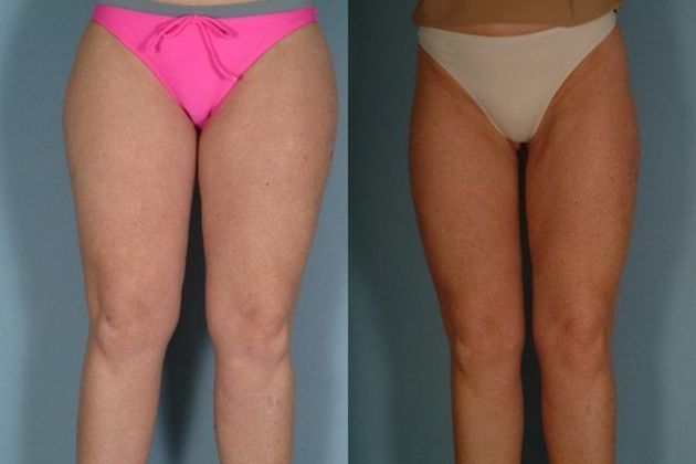Case 3 before and after liposuction procedure