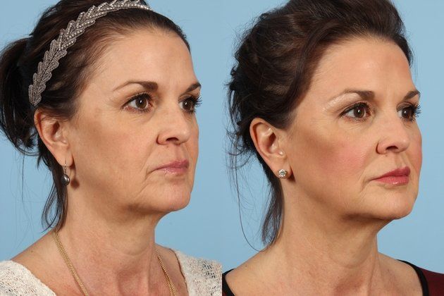 voluma injectables