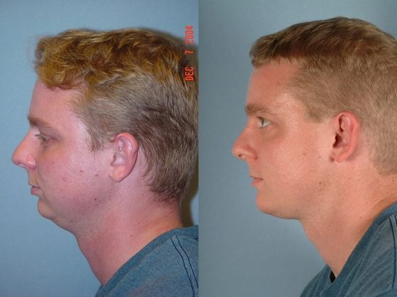 before and after chin surgery