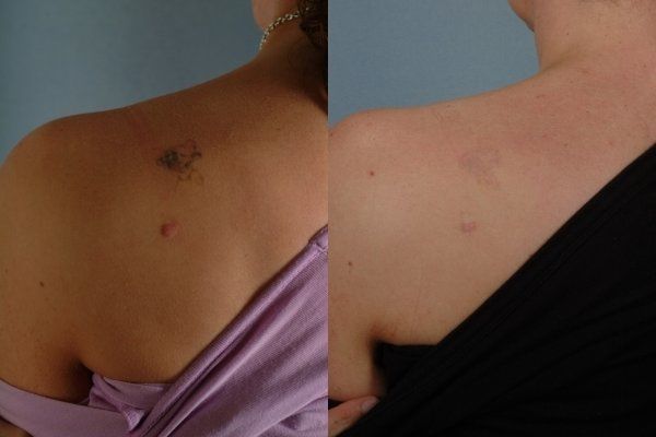tattoo removal before and after