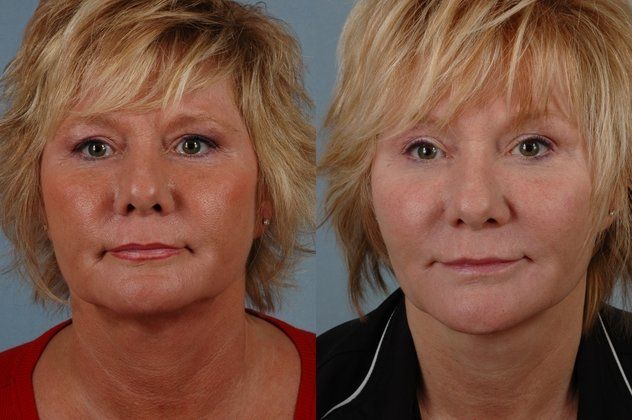 cosmetic injectables