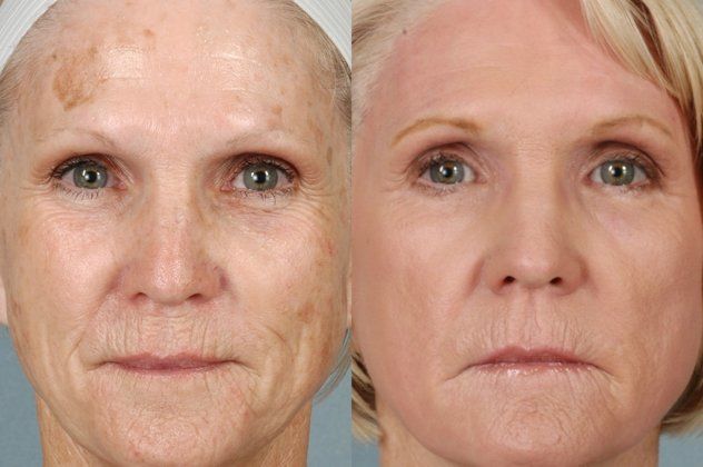 laser skin resurfacing