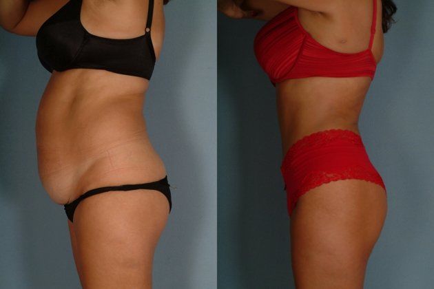 tummy tuck before and after