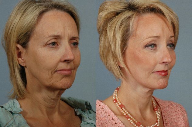 facelift before and after