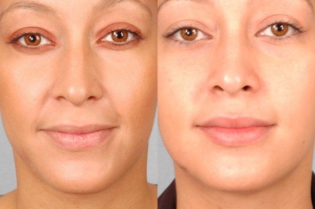 restylane